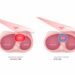 Deep Inspiratory Breath Hold (DIBH) is a game changing modern technique in Breast Cancer Radiotherapy