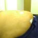 HCG Manavata Cancer Centre performs rare Robotic Surgery on Morbid Obese patient